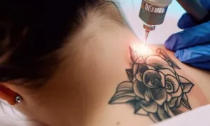 Small Tattoo Removal at Amplif'eyed